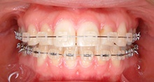 Clear Ceramic Braces