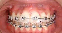 Metal Braces