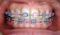 Metal Braces